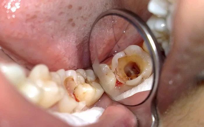 Truồng hợp cần lấy tủy răng