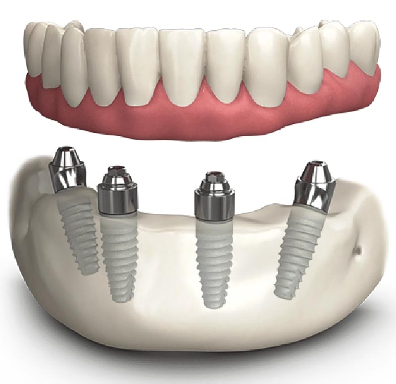 Trồng răng implant all on 4