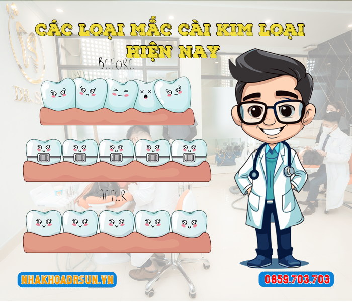 cac-loai-mac-cai-kim-loai-hien-nay