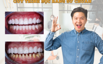 Quy trình bọc răng sứ chuẩn gồm những bước nào?