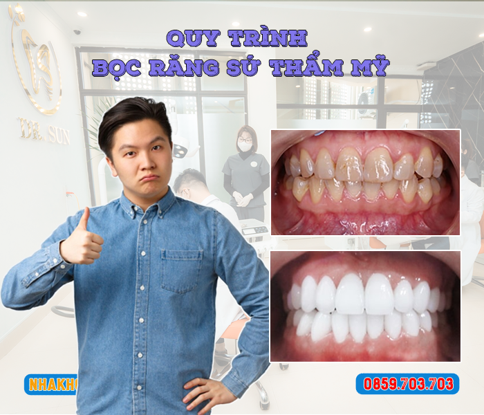 quy-trinh-boc-rang-su-tham-my
