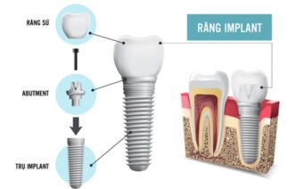 Giải đáp: Chi phí trồng răng implant bao nhiêu tiền?