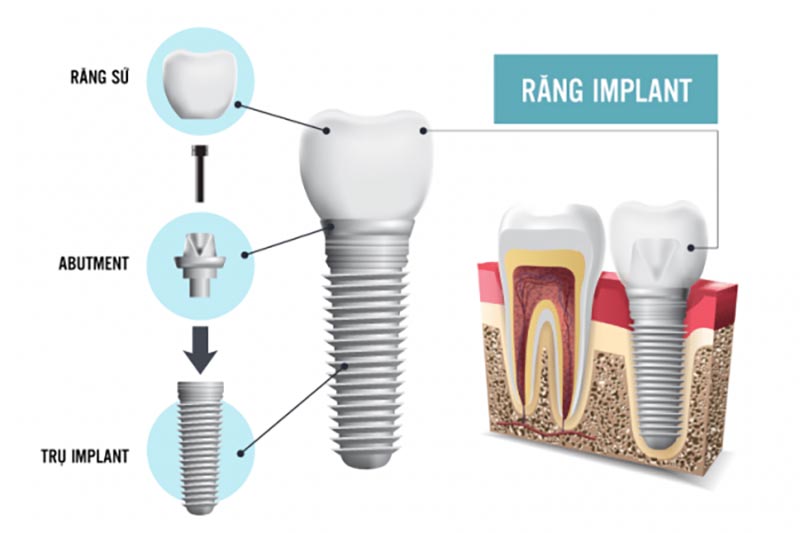 Chi phí trồng răng implant bao nhiêu tiền