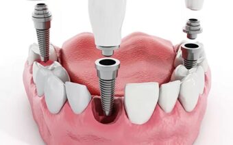 Trồng Răng Implant All On 4 Là Gì? Giá Bao Nhiêu?