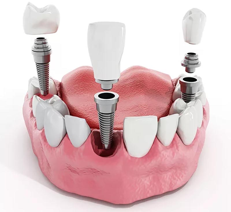 sau khi Trồng răng implant all on 4