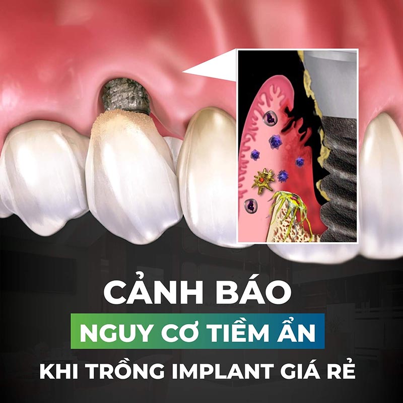 tác hại khi trồng răng implant giá rẻ