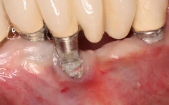 Những tác hại và biến chứng của việc trồng răng implant thất bại