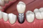 Mất răng lâu năm có trông implant được không