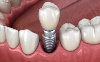 Mất răng lâu năm có trồng implant được không?