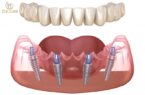 Trồng implant toàn hàm bao nhiêu tiên