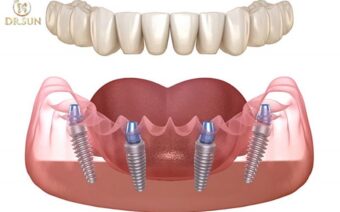 Trồng Răng Implant Toàn Hàm – All On 4, All On 6