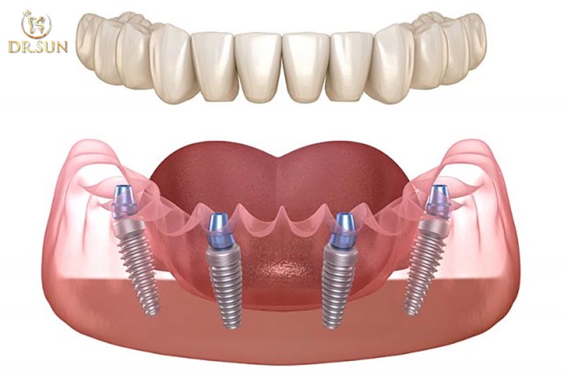 Trồng implant toàn hàm