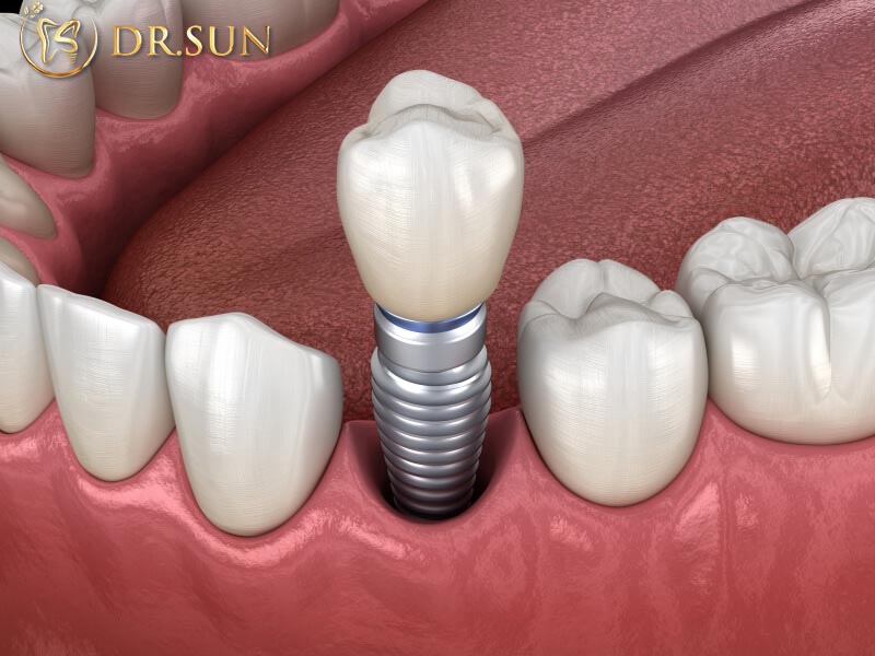 Mất răng lâu năm có trông implant được không
