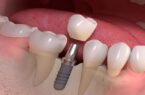 Chi phí trồng răng giả bao nhiêu tiền