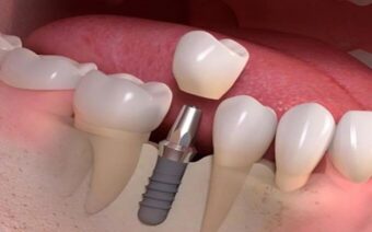 Mẹo tiết kiệm chi phí trồng răng có thể bạn chưa biết