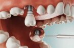 vị trí cấy implan bị nhiễm trùng
