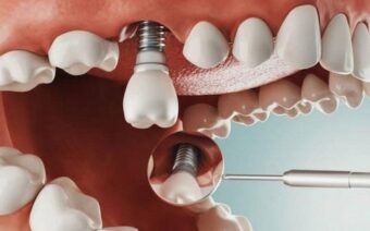 Trồng răng implant có nguy hiểm không?