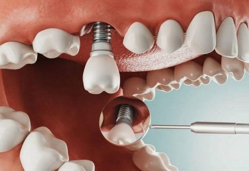 vị trí cấy implan bị nhiễm trùng