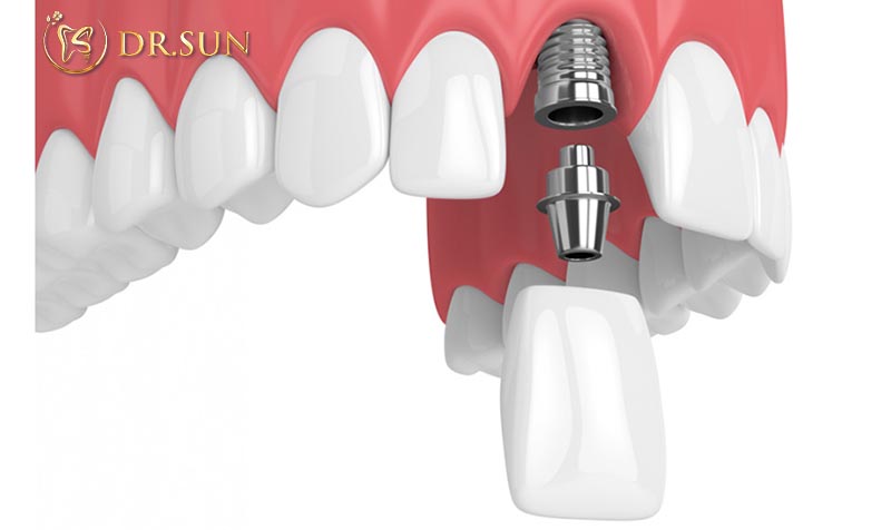 Trồng răng của cố định