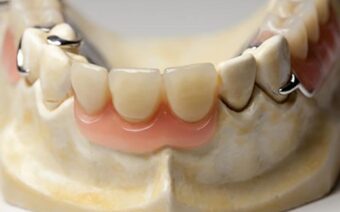 Trồng răng cửa bị gãy cố định bao nhiêu tiền?