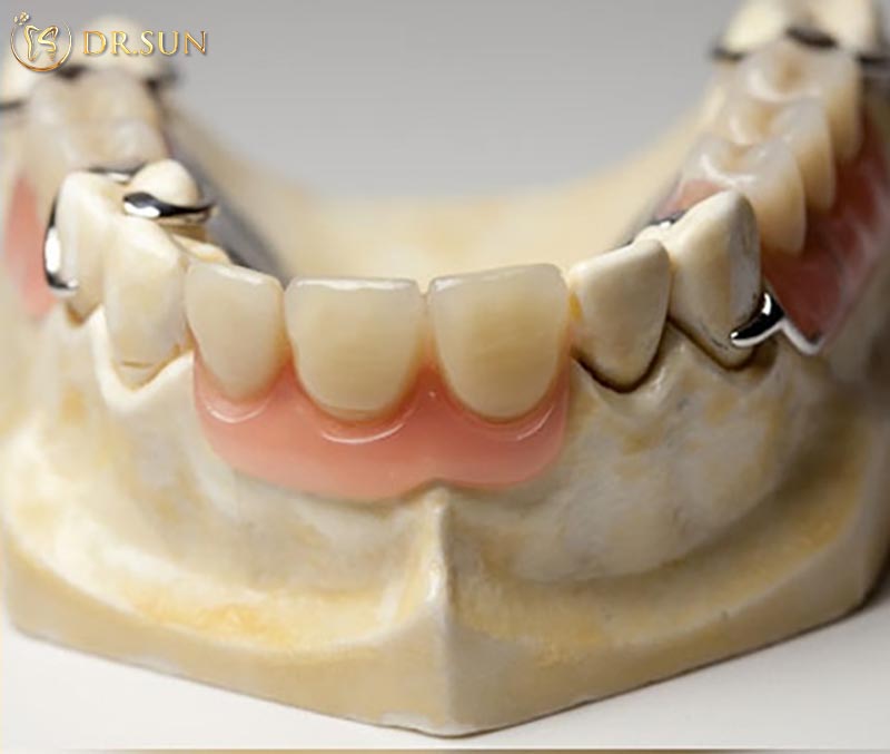 Trồng răng cửa tháo lắp