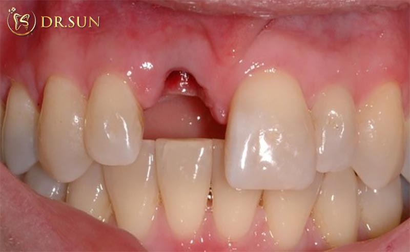Trồng răng cửa bị gãy