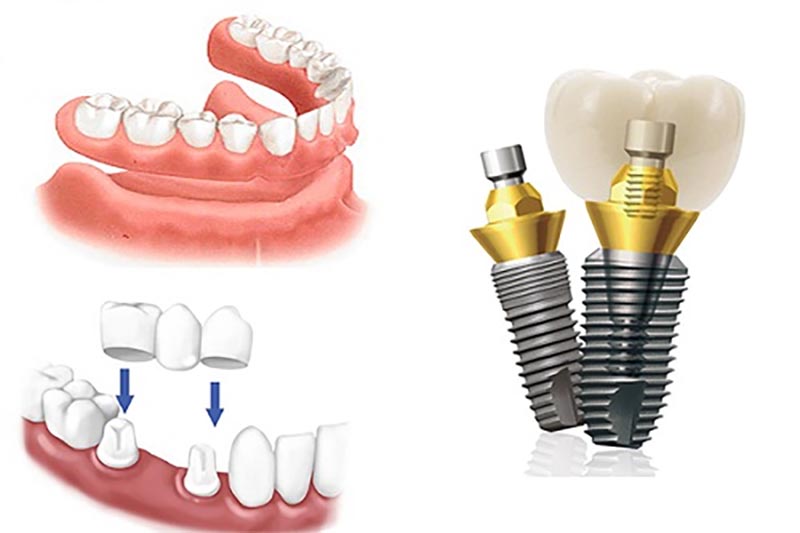 Trồng răng giả loại nào tốt nhất