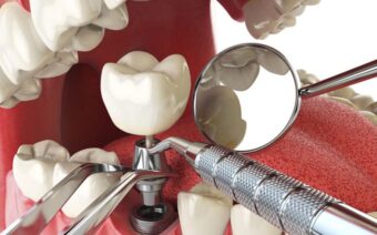 Tại sao nên trồng răng hàm? Trồng răng có đau không?