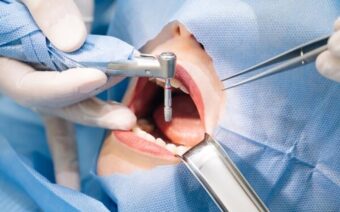 Trồng răng có đau không? Trồng răng giả ở đâu an toàn, không đau?