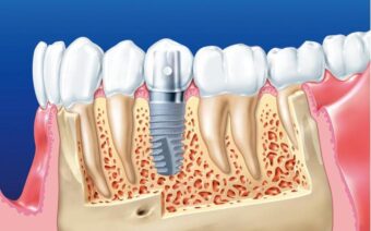 Trồng răng giả loại nào tốt nhất? Chi phí bao nhiêu tiền