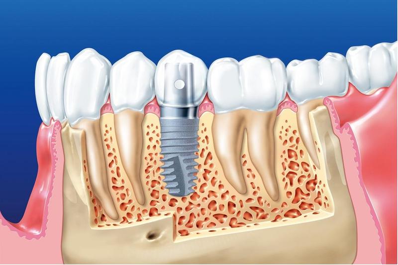 trồng răng implant