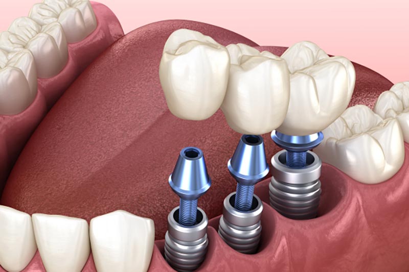 trồng răng implant thất bại