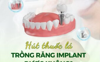 HÚT THUỐC LÁ CÓ TRỒNG RĂNG IMPLANT ĐƯỢC KHÔNG?