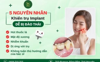 5 Nguyên Nhân Khiến Trụ Implant Dễ Bị Đào Thải