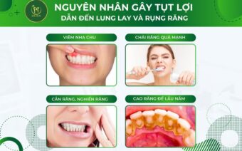 NGUYÊN NHÂN GÂY TỤT LỢI KHIẾN LUNG LAY VÀ RỤNG RĂNG