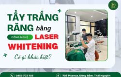 Tẩy Trắng Răng Bằng Công Nghệ Laser Whitening: Có Gì Khác Biệt?