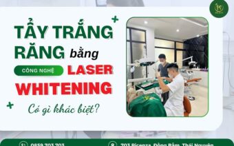 Tẩy Trắng Răng Bằng Công Nghệ Laser Whitening: Có Gì Khác Biệt?