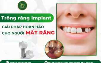 TRỒNG RĂNG IMPLANT – GIẢI PHÁP HOÀN HẢO CHO NGƯỜI MẤT RĂNG